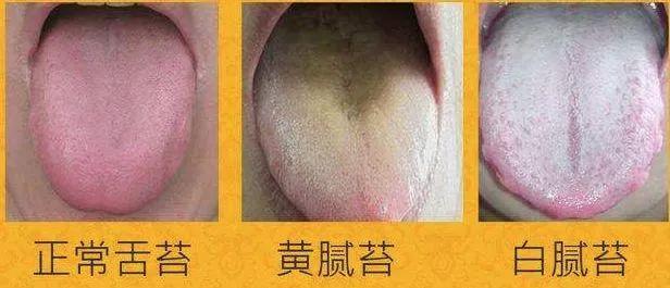 探索中医舌诊，透视健康状况的古老智慧
