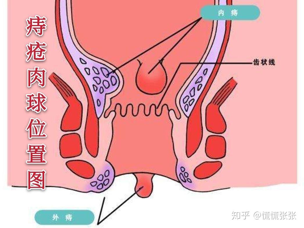 痔疮除外保险，健康保障的特殊选择